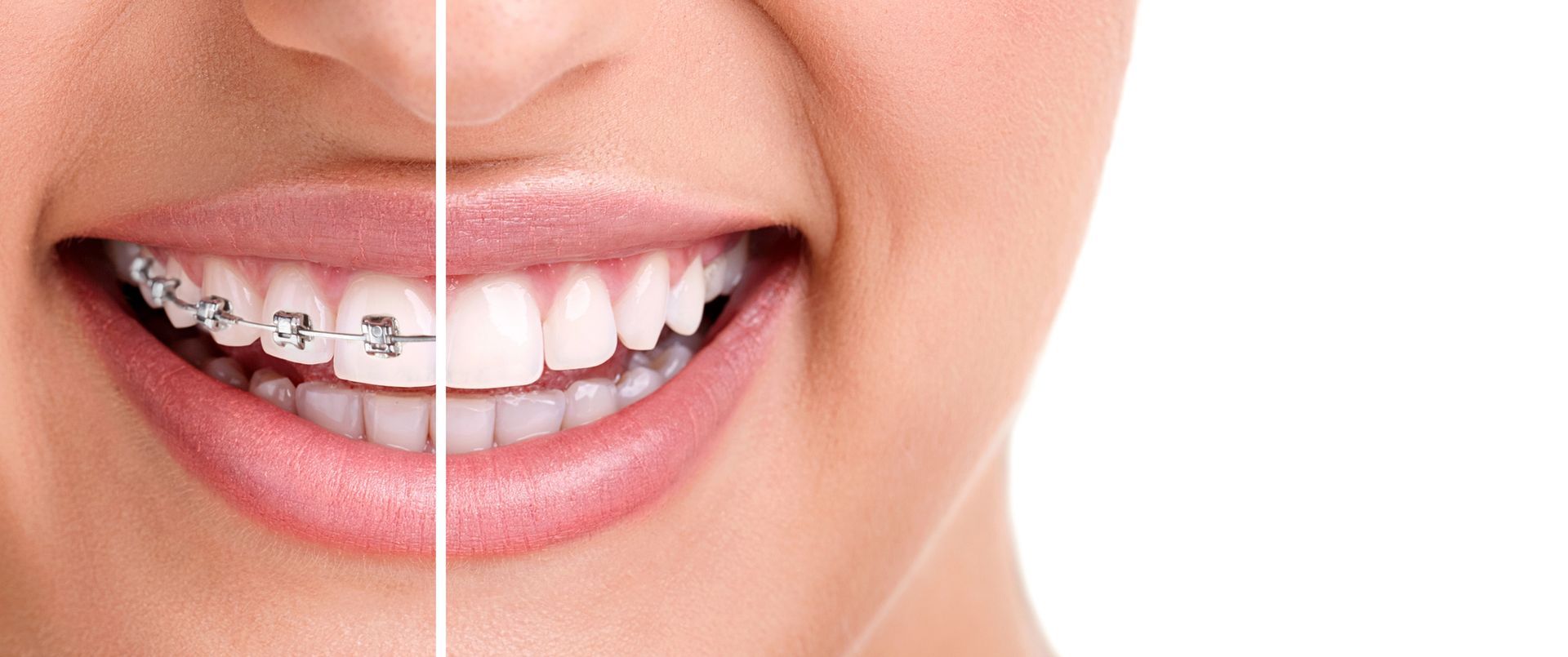 Confronto tra immagini divise: denti con apparecchio metallico a sinistra e un sorriso naturale a destra.