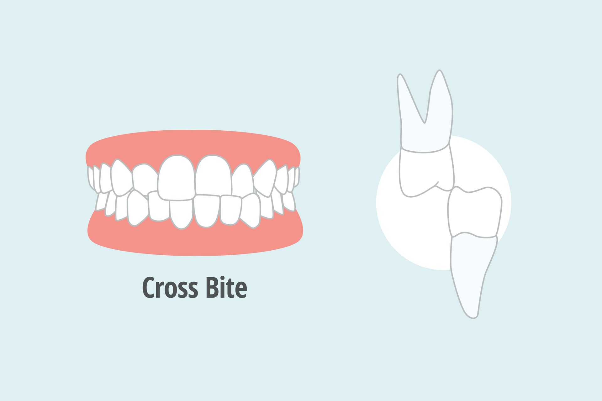 Crossbites Treatment in Plymouth, MA