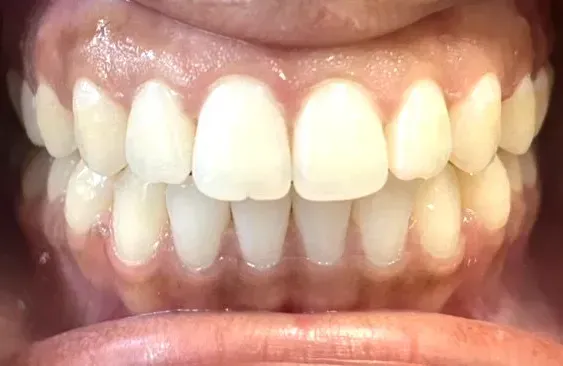 Invisalign Treatment by Dr. Helga Idrizi at Plymouth Bay Dental