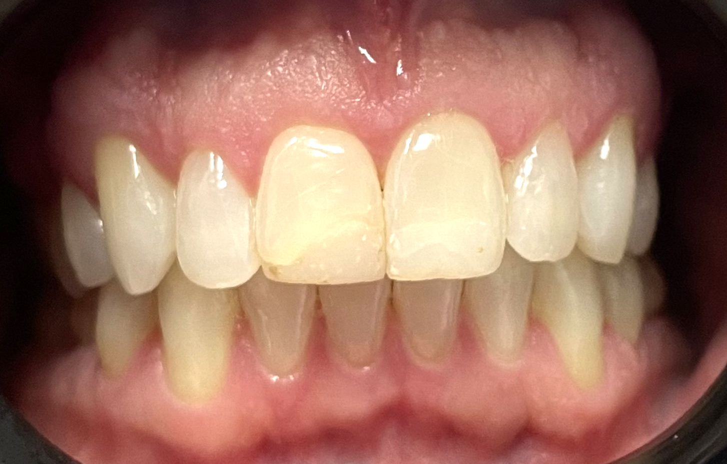 Invisalign results