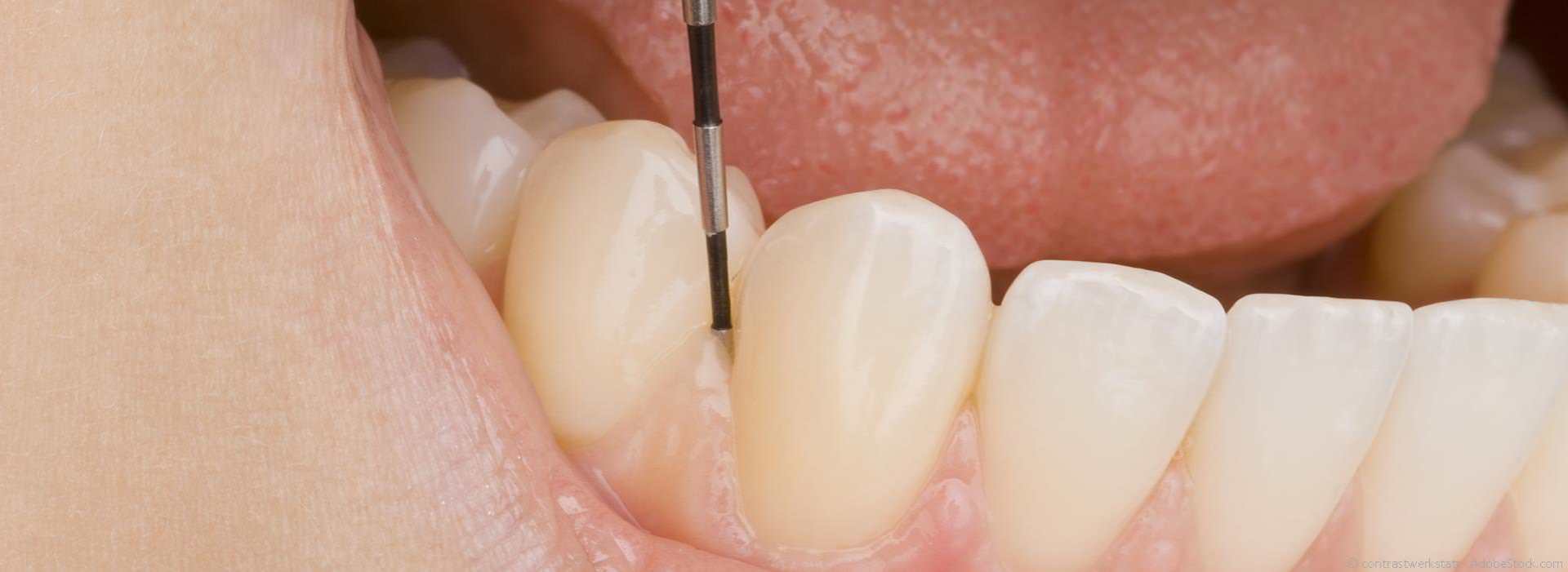 Was ist eine Parodontitis?