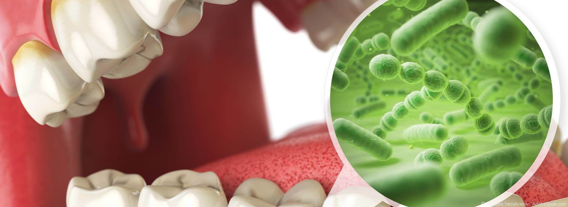 Wodurch entsteht eine Parodontitis?