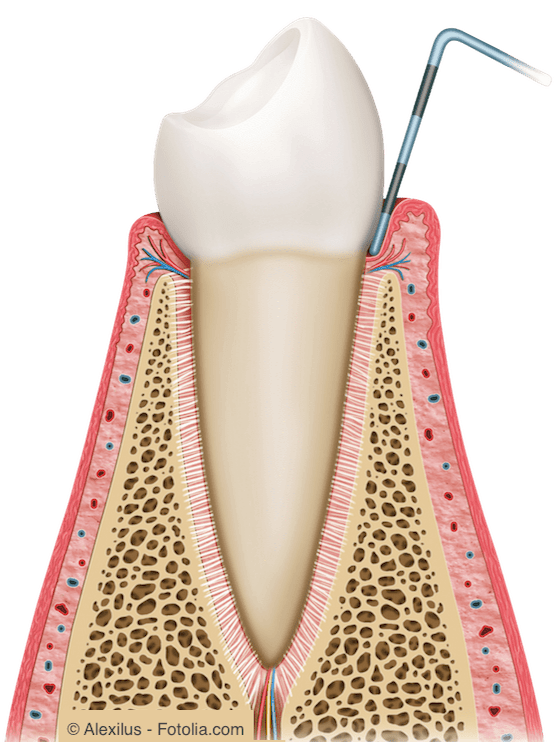 Gesundes Zahnfleisch liegt dem Zahn eng an.
