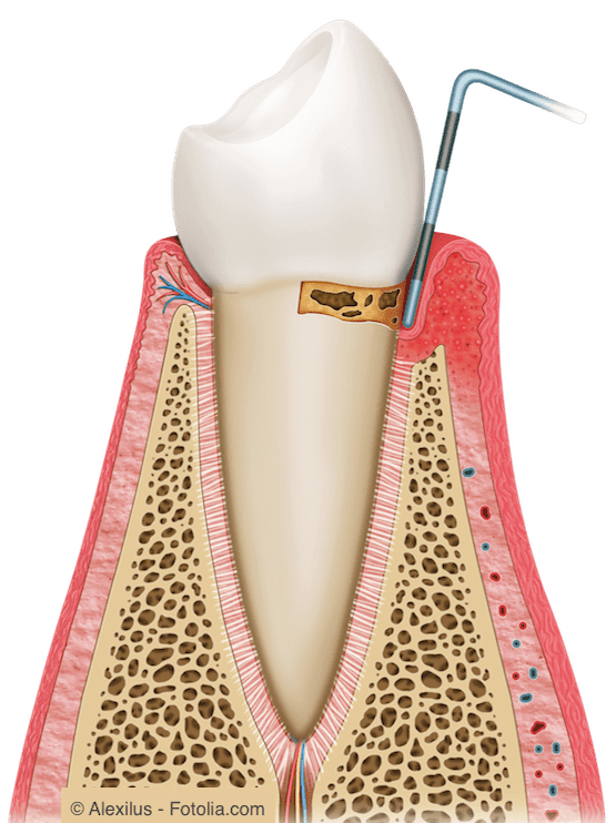 Bei einer Entzündung löst sich das Zahnfleisch vom Zahn und es entsteht eine Zahnfleischtasche.