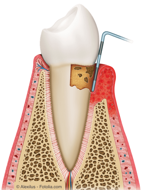 Bei einer Parodontitis baut sich der Zahnhalteapparat allmählich ab.