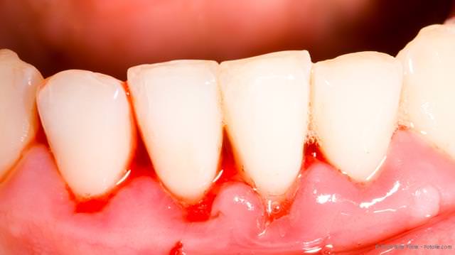 Woran erkennt man eine Parodontitis? Woran erkennt man eine Parodontitis?