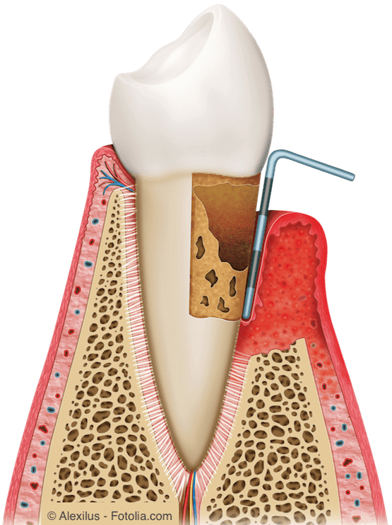 Langfristig und unbehandelt führt eine Parodontitis zu Zahnlockerungen und Zahnverlust.