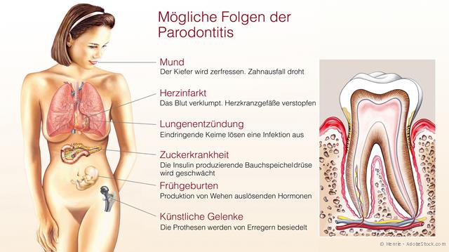 Warum gefährdet eine Parodontitis die Gesundheit? Warum gefährdet eine Parodontitis die Gesundheit?