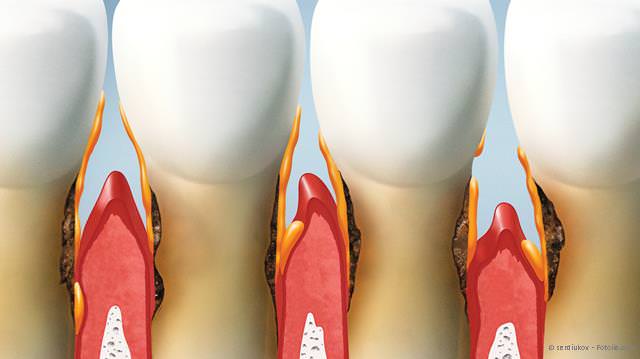 Fragen und Antworten zur Parodontitis Fragen und Antworten zur Parodontitis