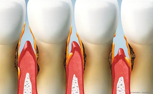 Parodontitis: Rückgang des Zahnfleisches und Abbau des Kieferknochens