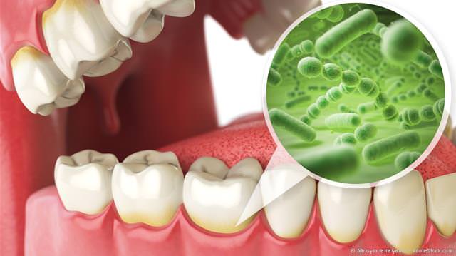 Bestimmte Bakterienarten in Zahnbelägen sind die Hauptverursacher einer Parodontitis.