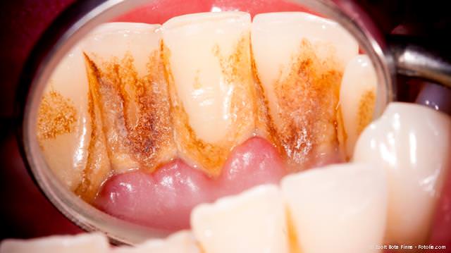 Harter und weicher Zahnbelag enthält Bakterien, die eine Parodontitis verursachen können.