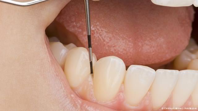 Untersuchung des Zahnfleisches mit der Parodontalsonde