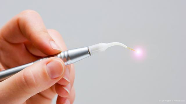 Dental-Laser: Unblutig und schmerzarm