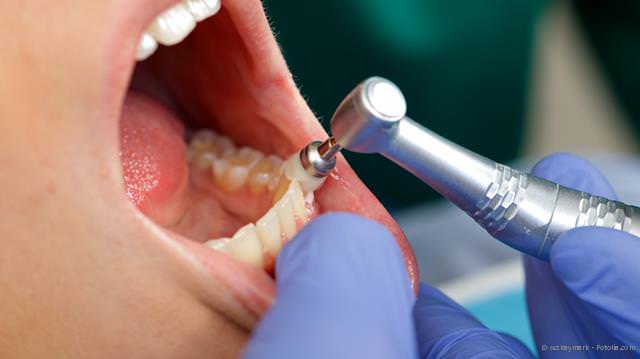 Professionelle Zahnreinigung (PZR) als Vorbehandlung