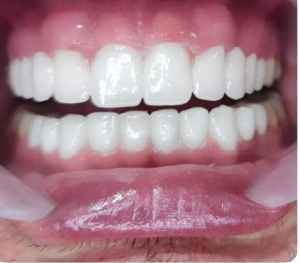 How Much Do Veneers Cost In Turkey? (2022) Complete Breakdown