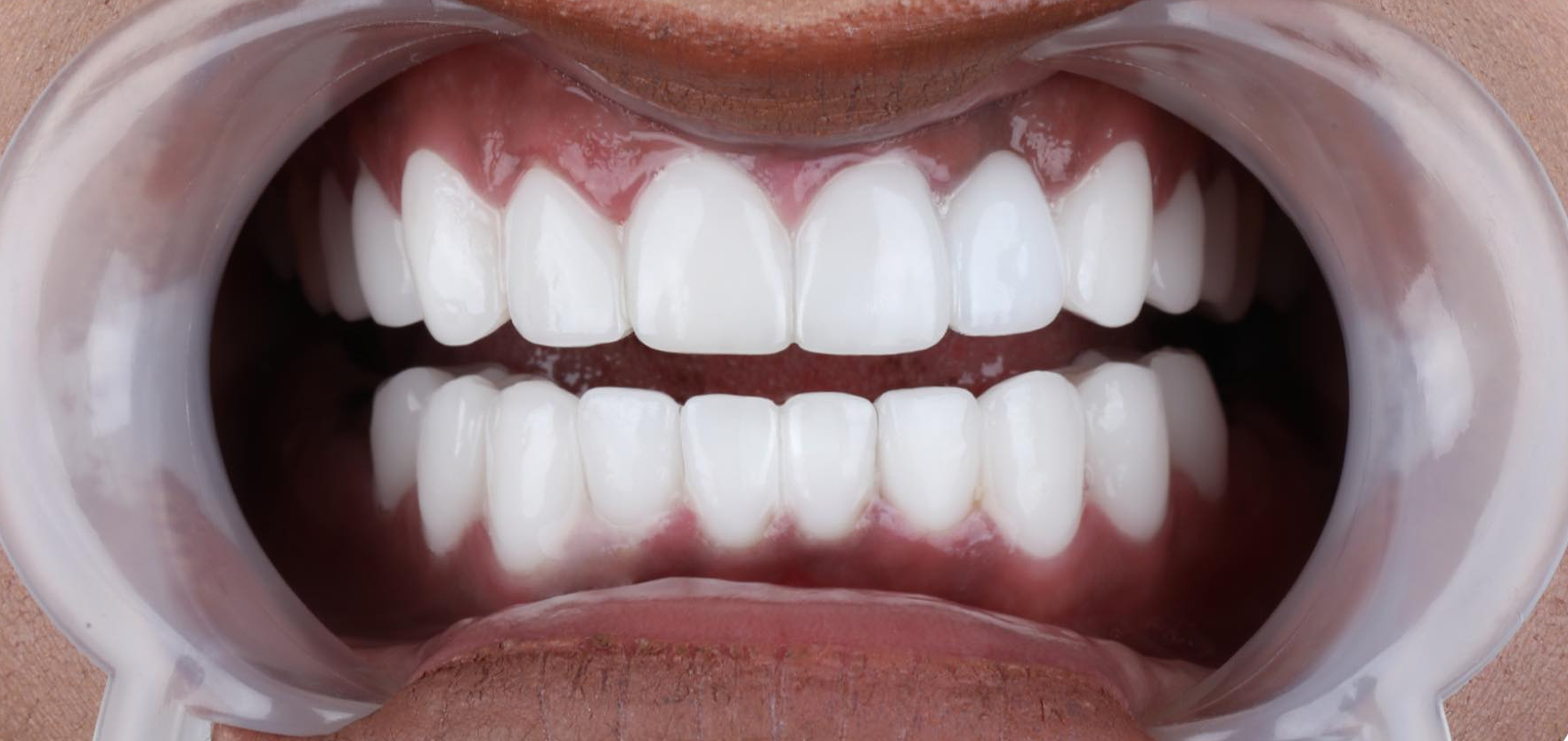 How Much Do Veneers Cost In Turkey? (2022) Complete Breakdown