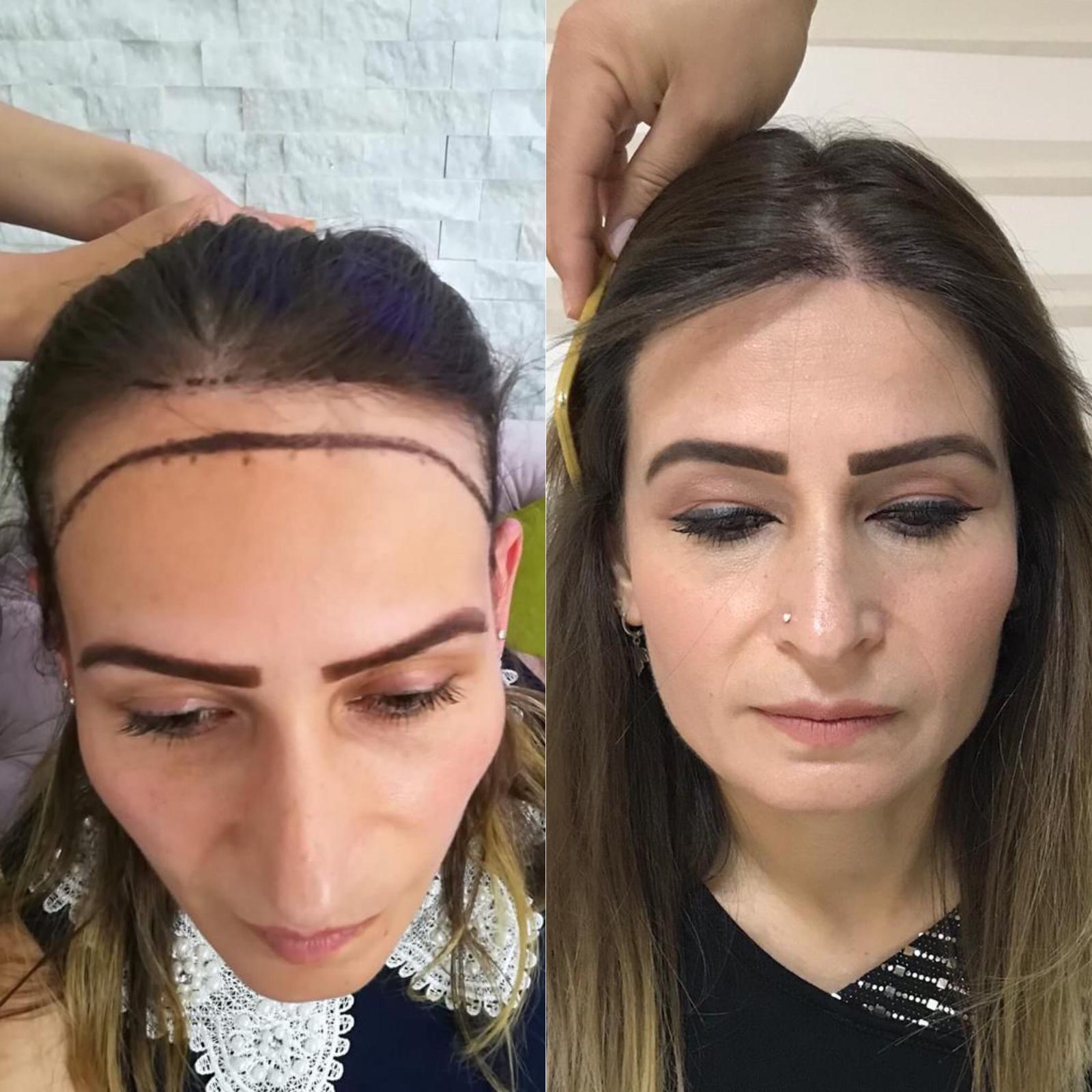 is-turkey-the-best-place-for-a-hair-transplant