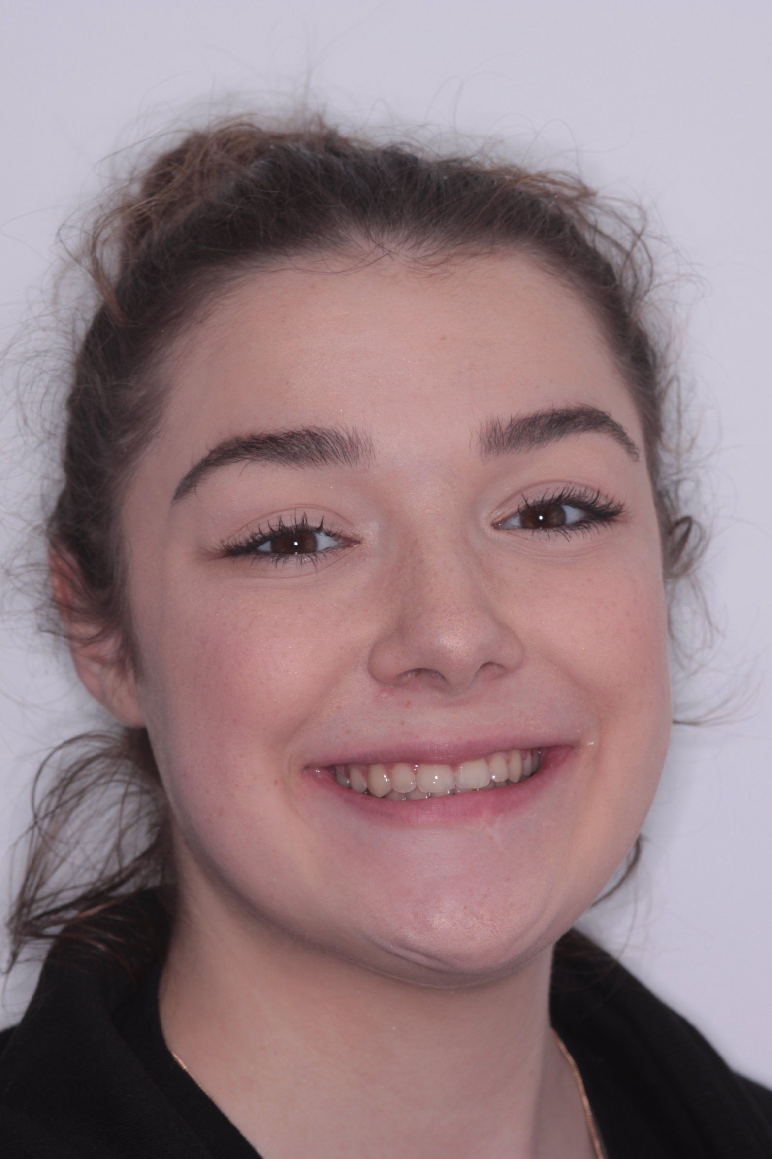 Amelia after orthodontics