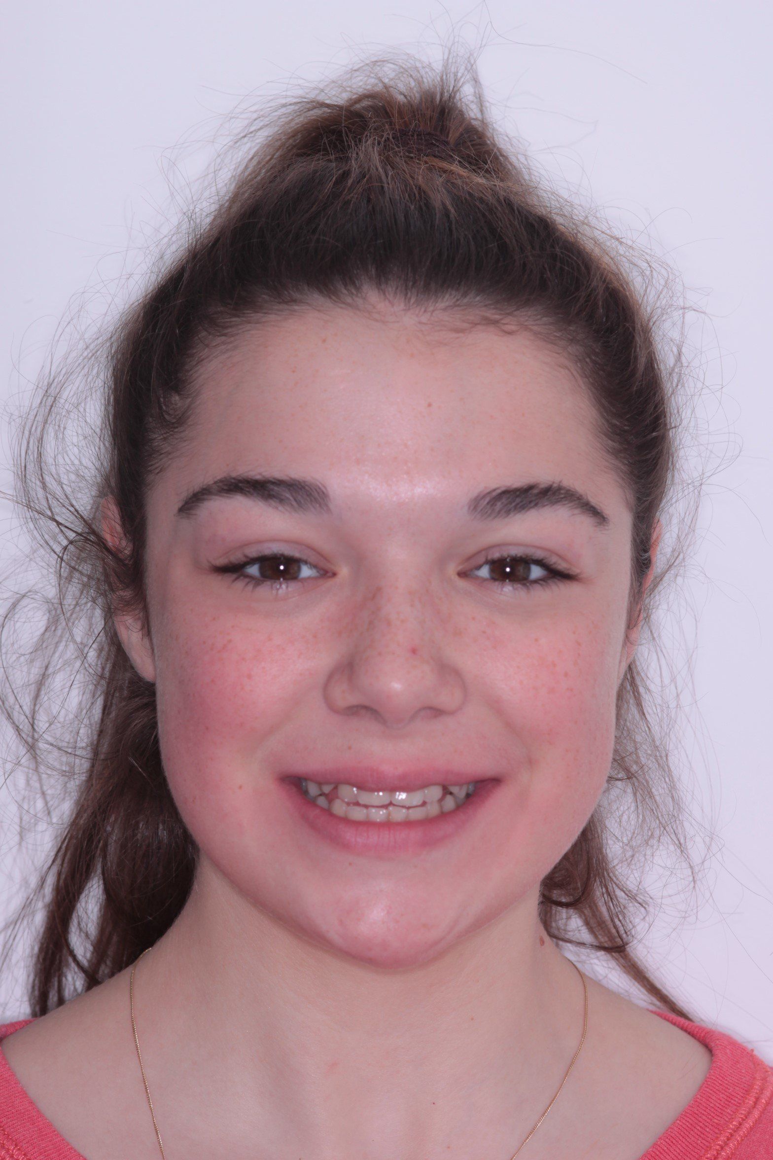 Amelia before orthodontics