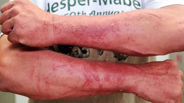 a man holds up his arms showing a rash caused by wild parsnips