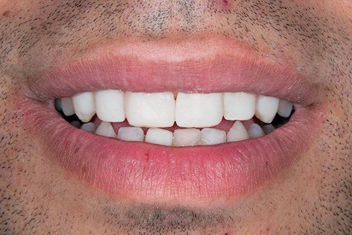 photo after invisalign treatment