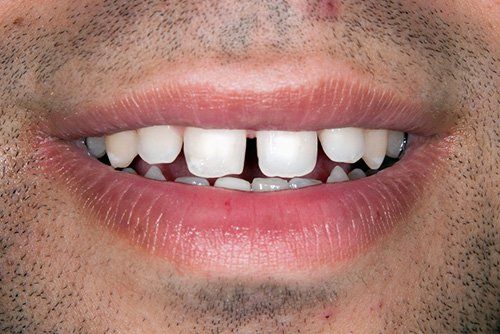 photo before invisalign treatment