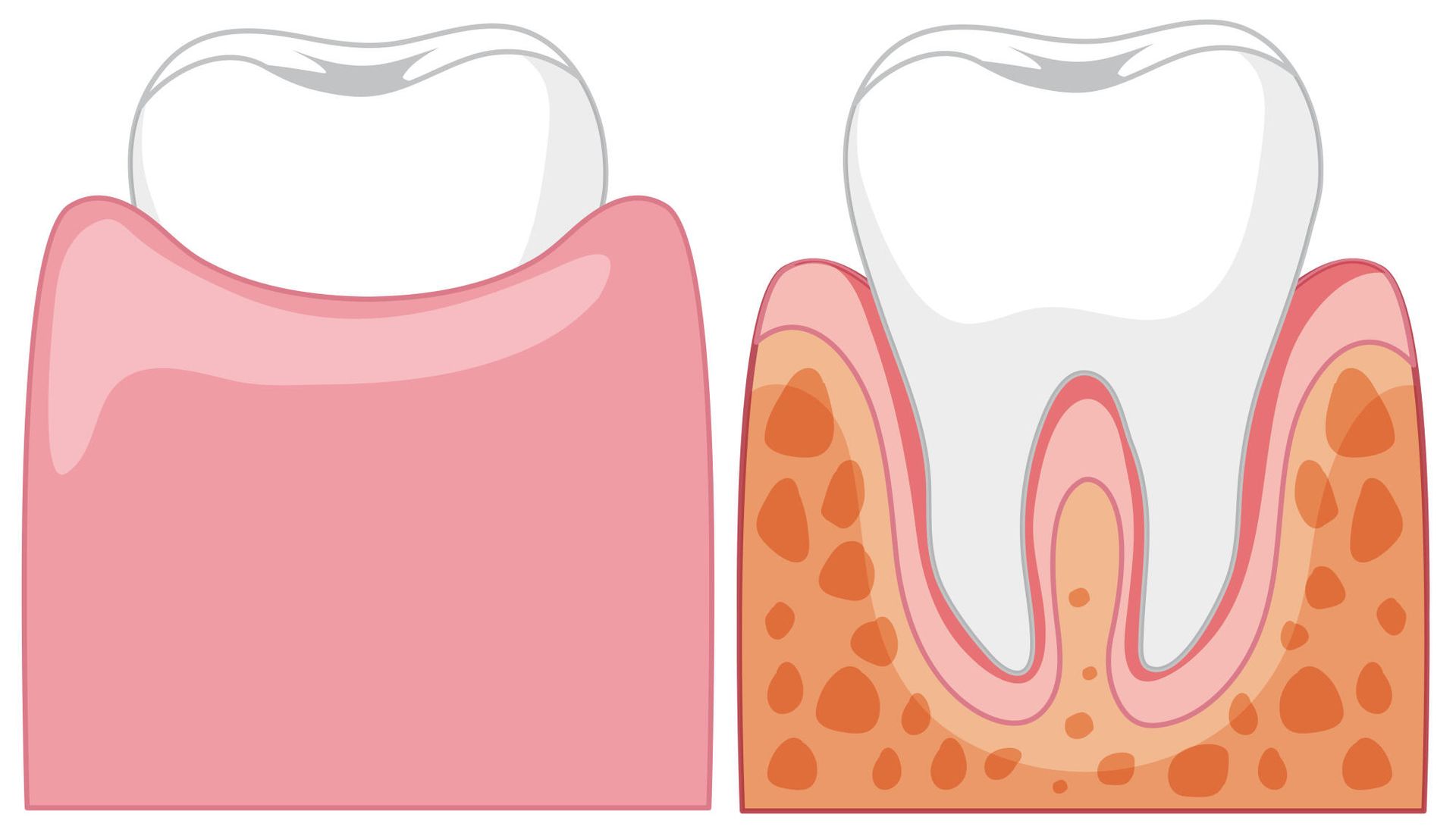 A tooth with a crown and a tooth without a crown on a white background.