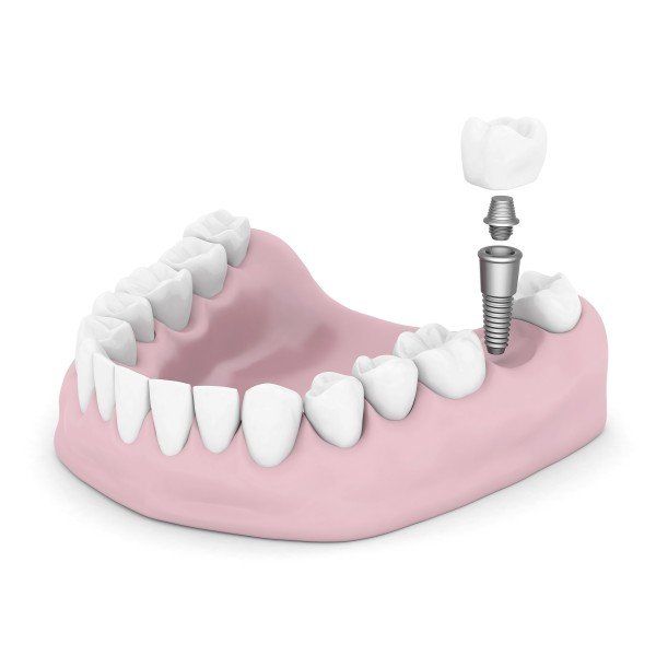 3D model of dental implant