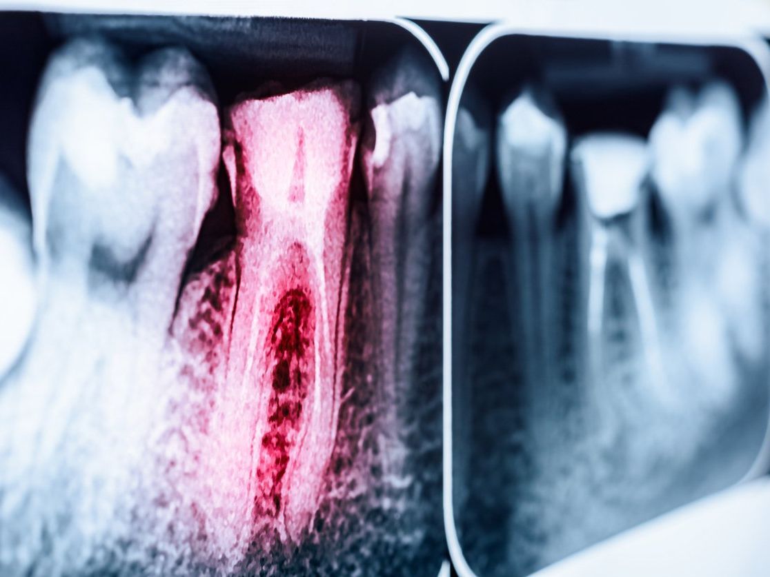 A close up of an x-ray of a tooth with a hole in it.