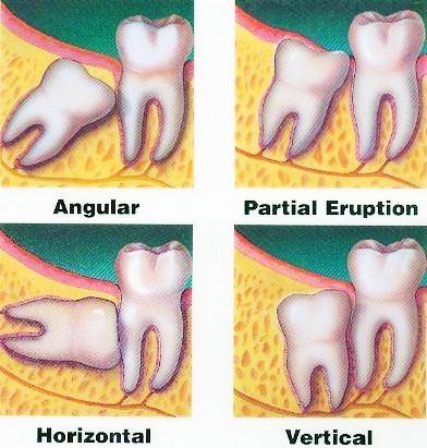illustration what could wisdom teeth would do to other teeth