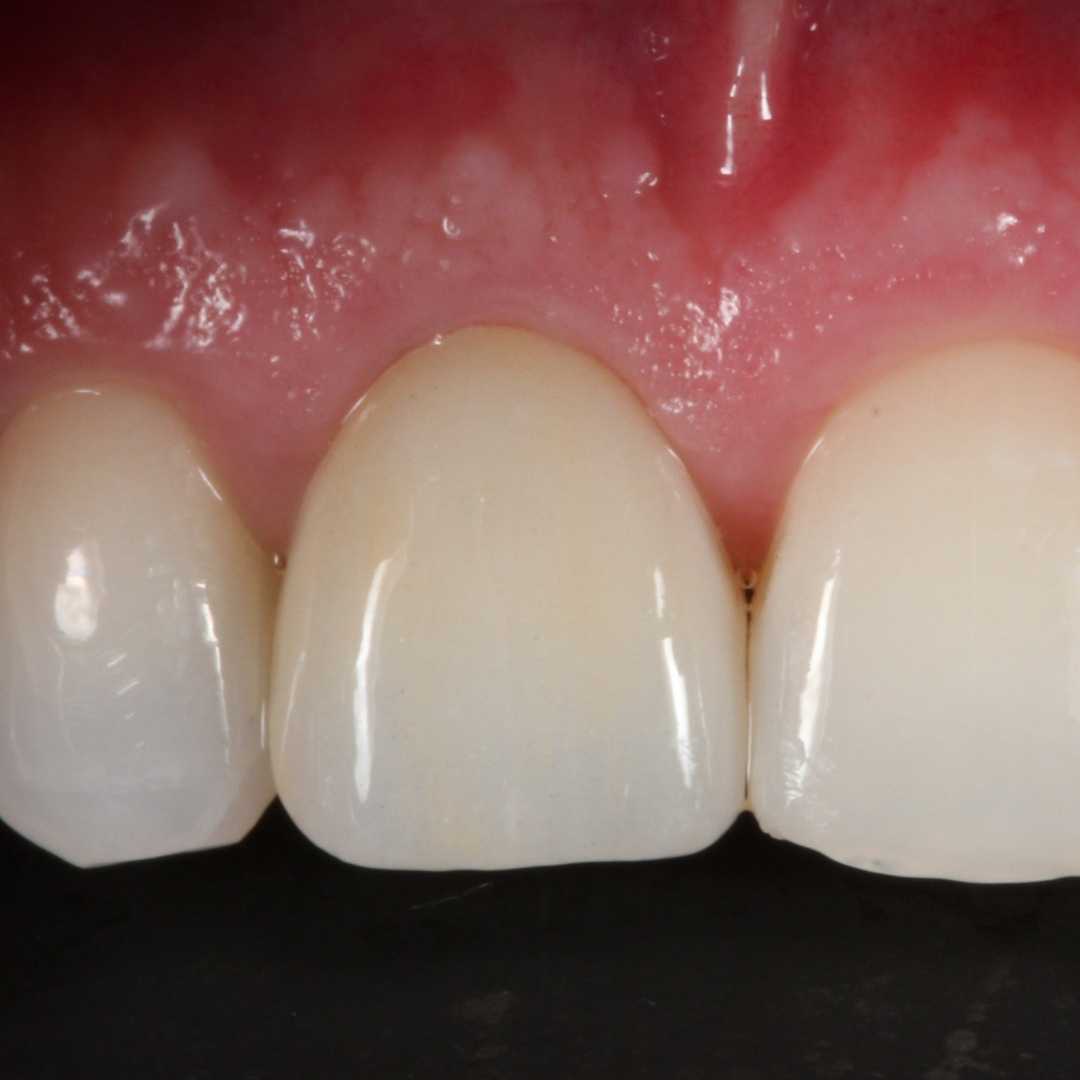 natural cosmetic dental implant near me