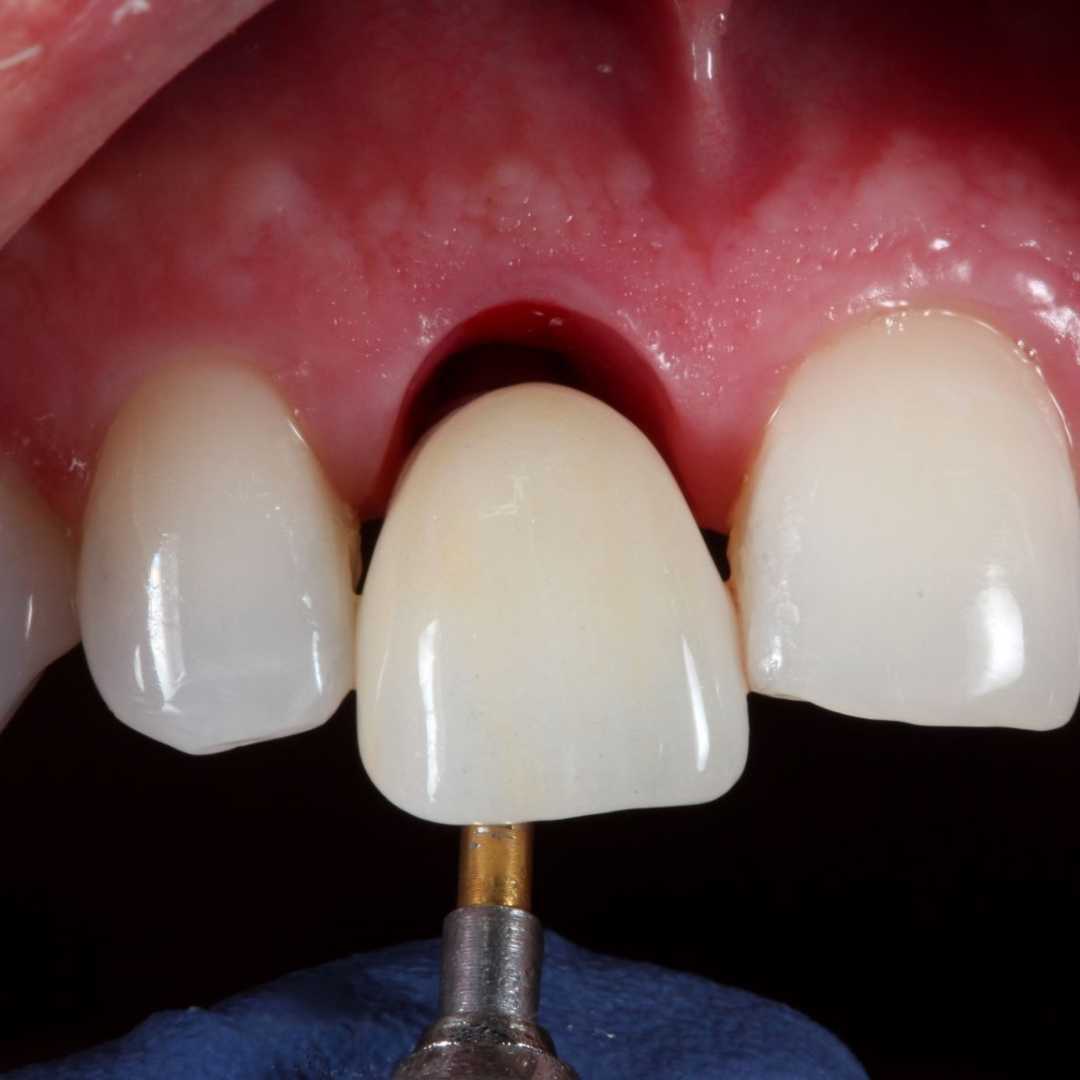 cosmetic implant best near me