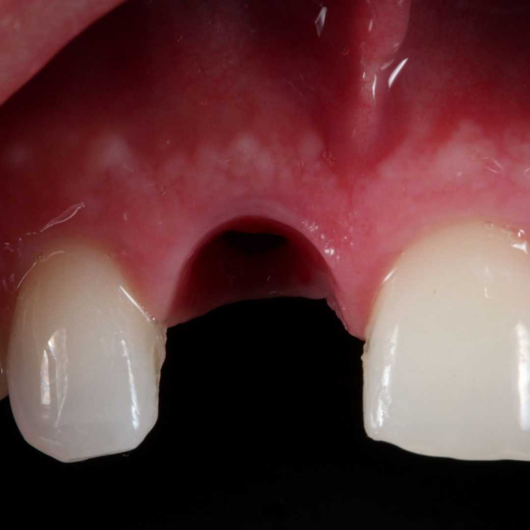 best minimally invasive e