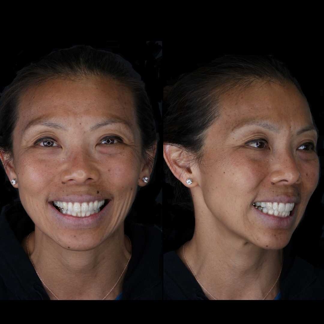 cosmetic smile natural appearance skilled implant dentist near me