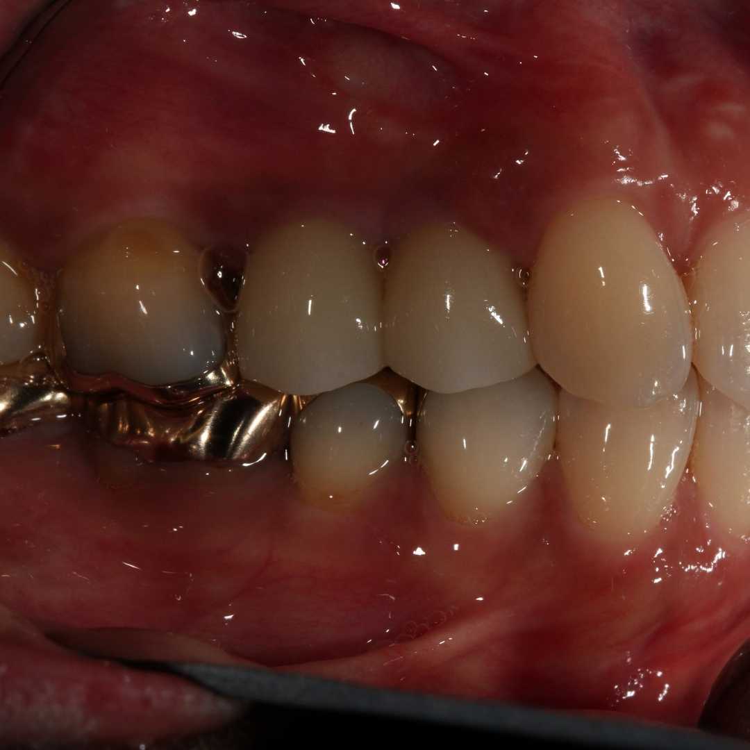 dental implant smile bite pain free near me