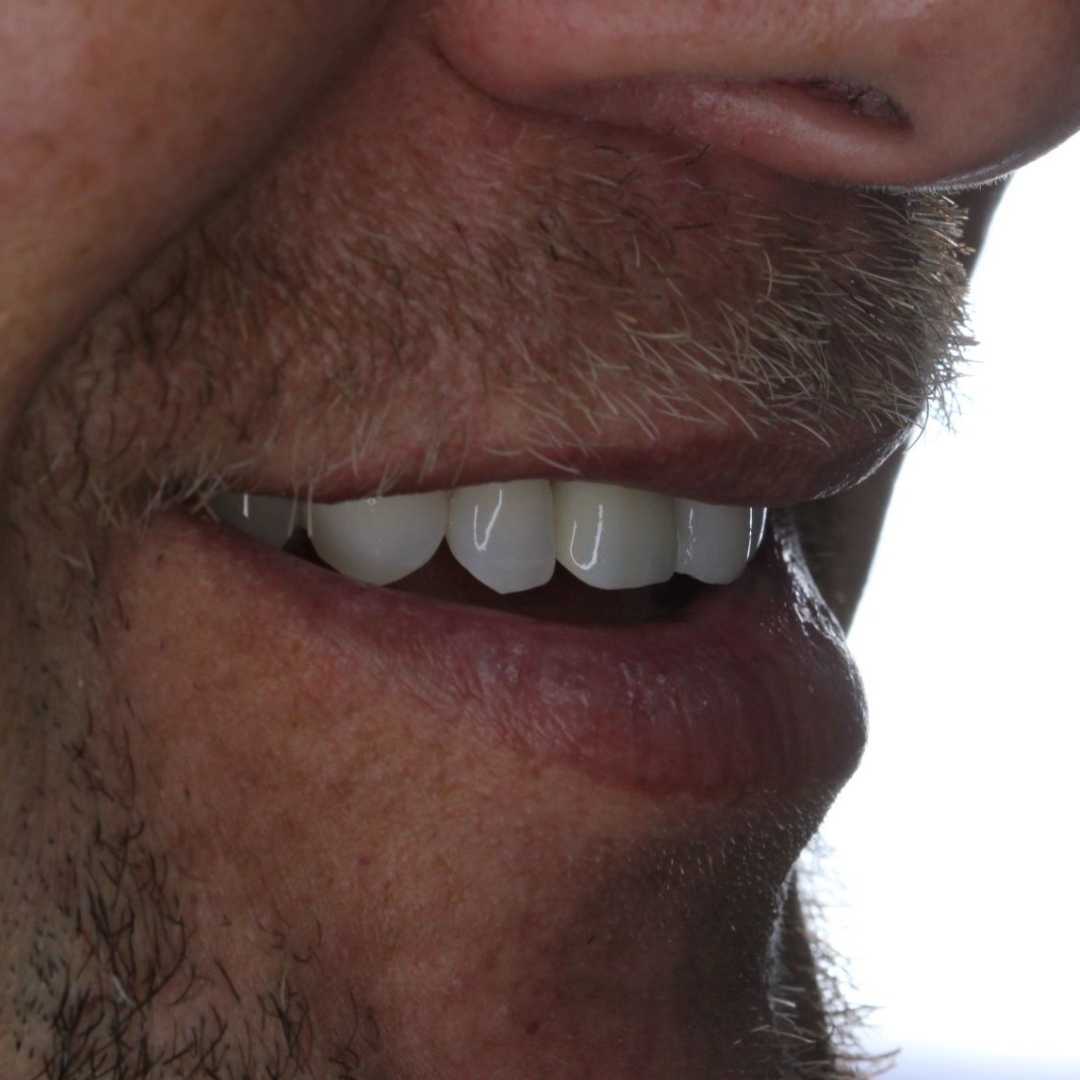 dental implant high quality affordable near me