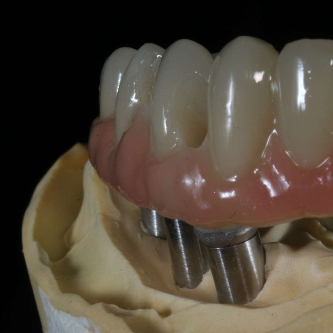 full arch implant best local dentist near me