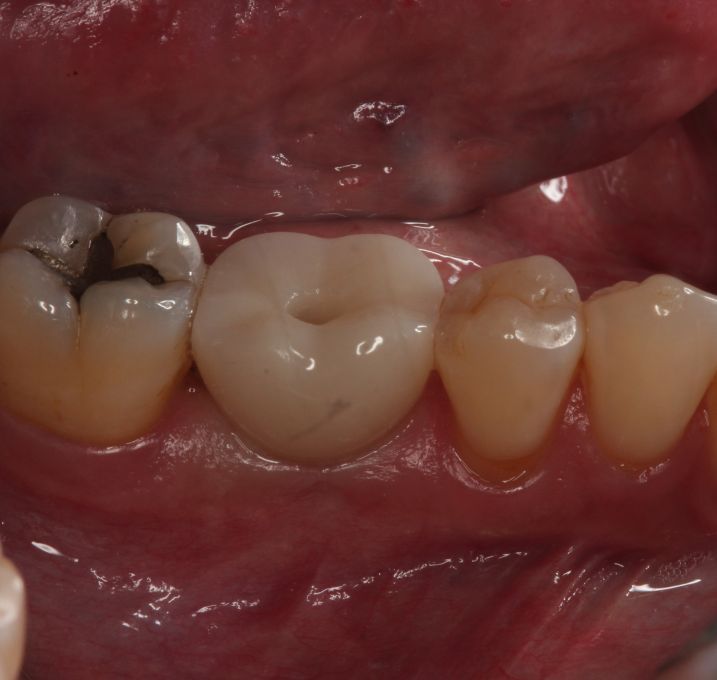 dental implant cost near me simple implant
