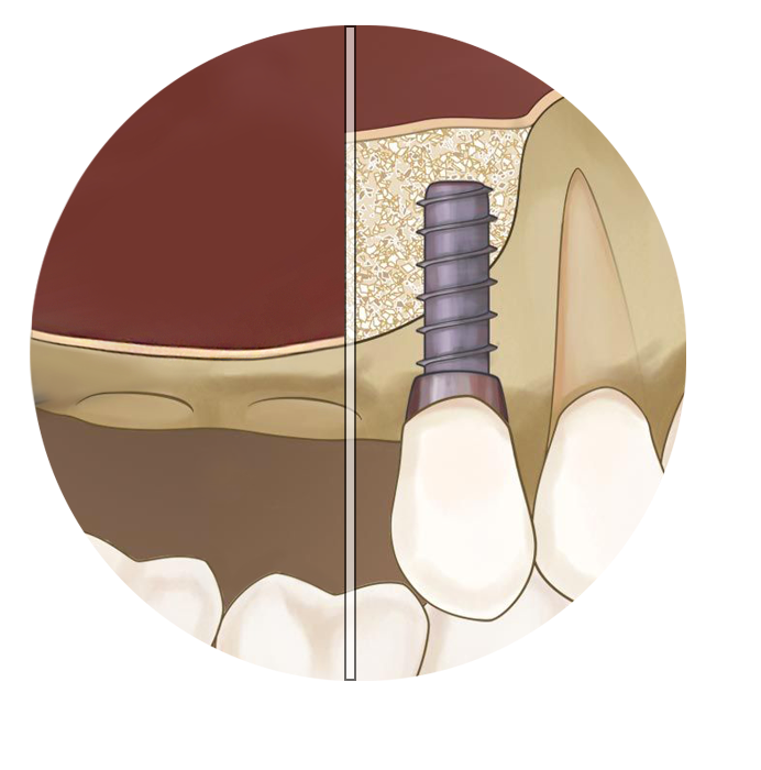 implant cost with bone graft sinus lift 