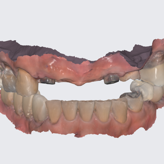 dental implant intraoral scan
