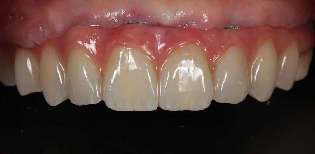 smile makeover same day full smile replacement near me