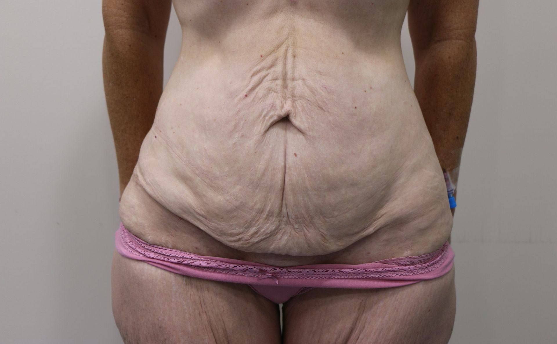 After Post Weight Loss Surgery