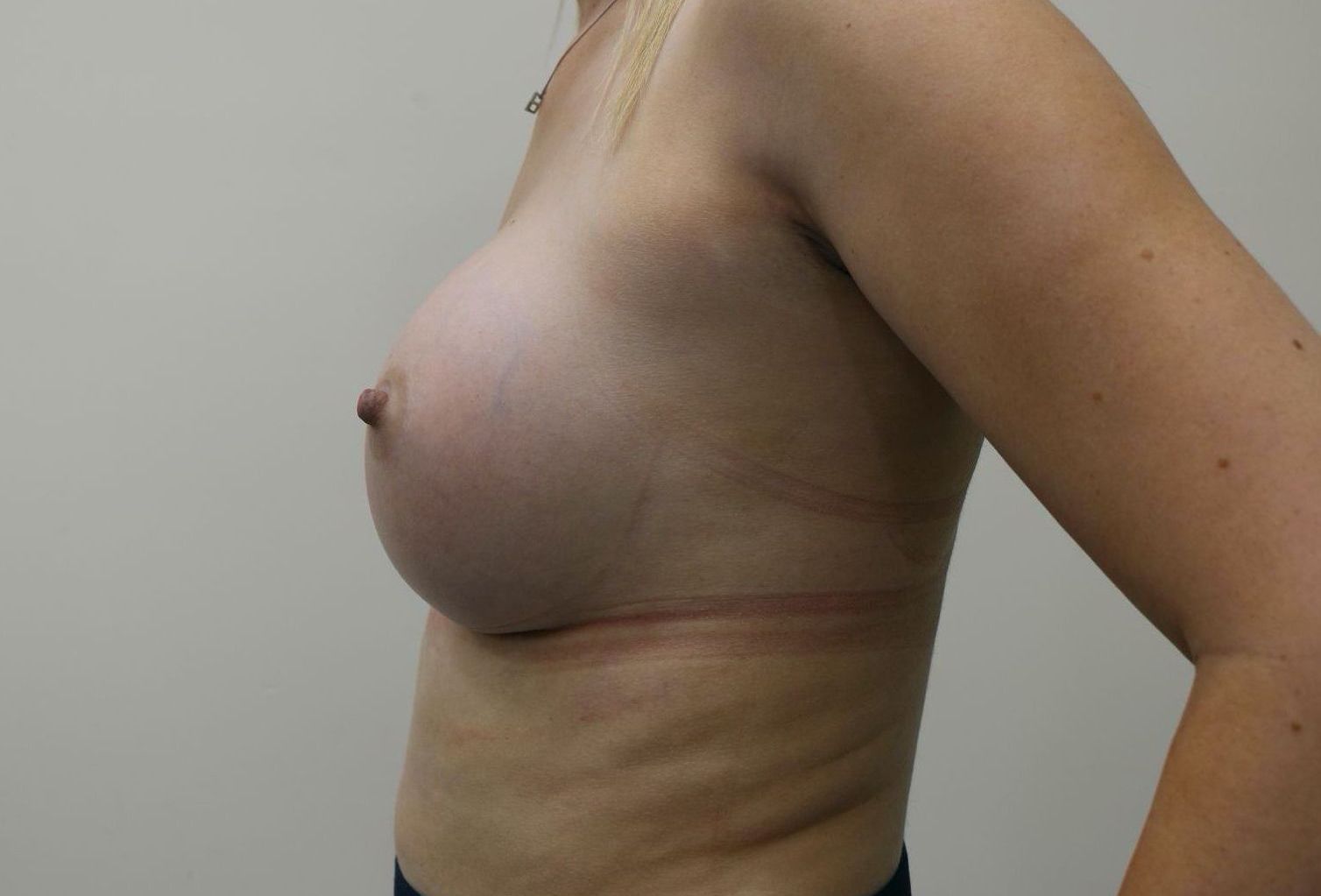 Breast Augmentation After