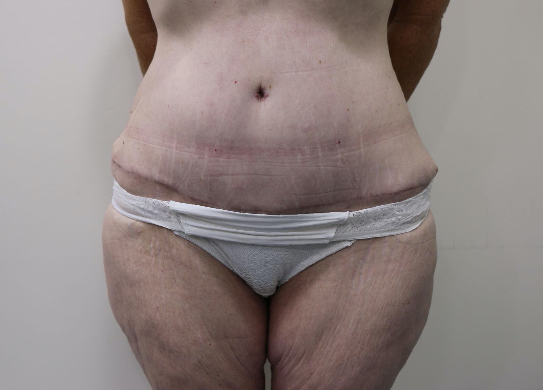 Post Weight Loss Surgery After