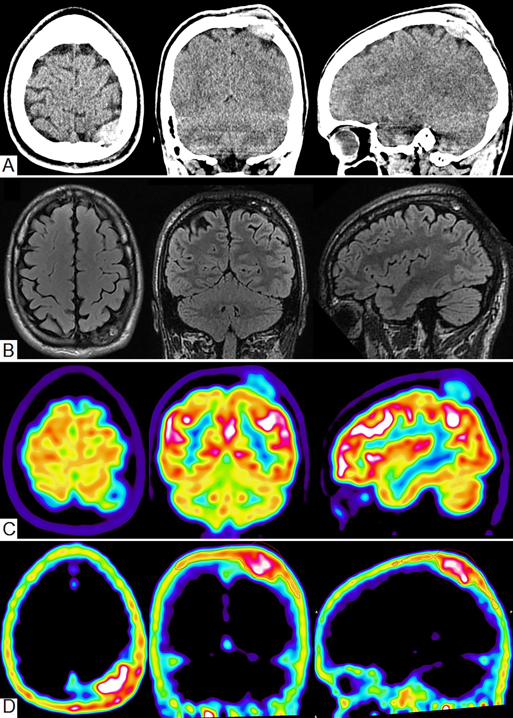 Un collage de imágenes del cerebro de una persona.