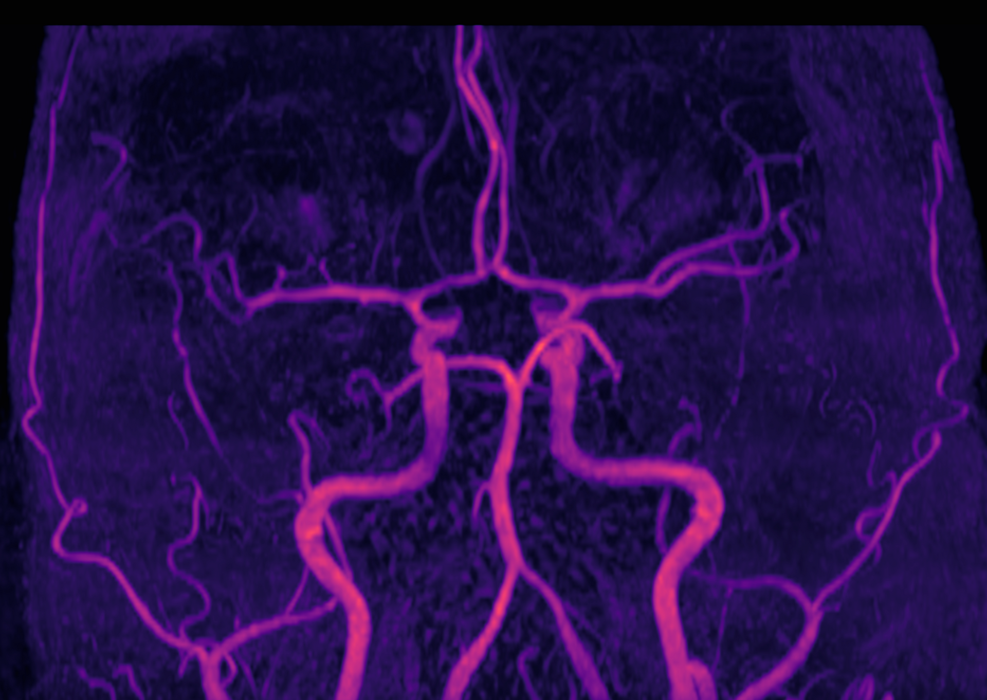 Dr. Martinez Manrique en una Cirugía Tumor Cerebral