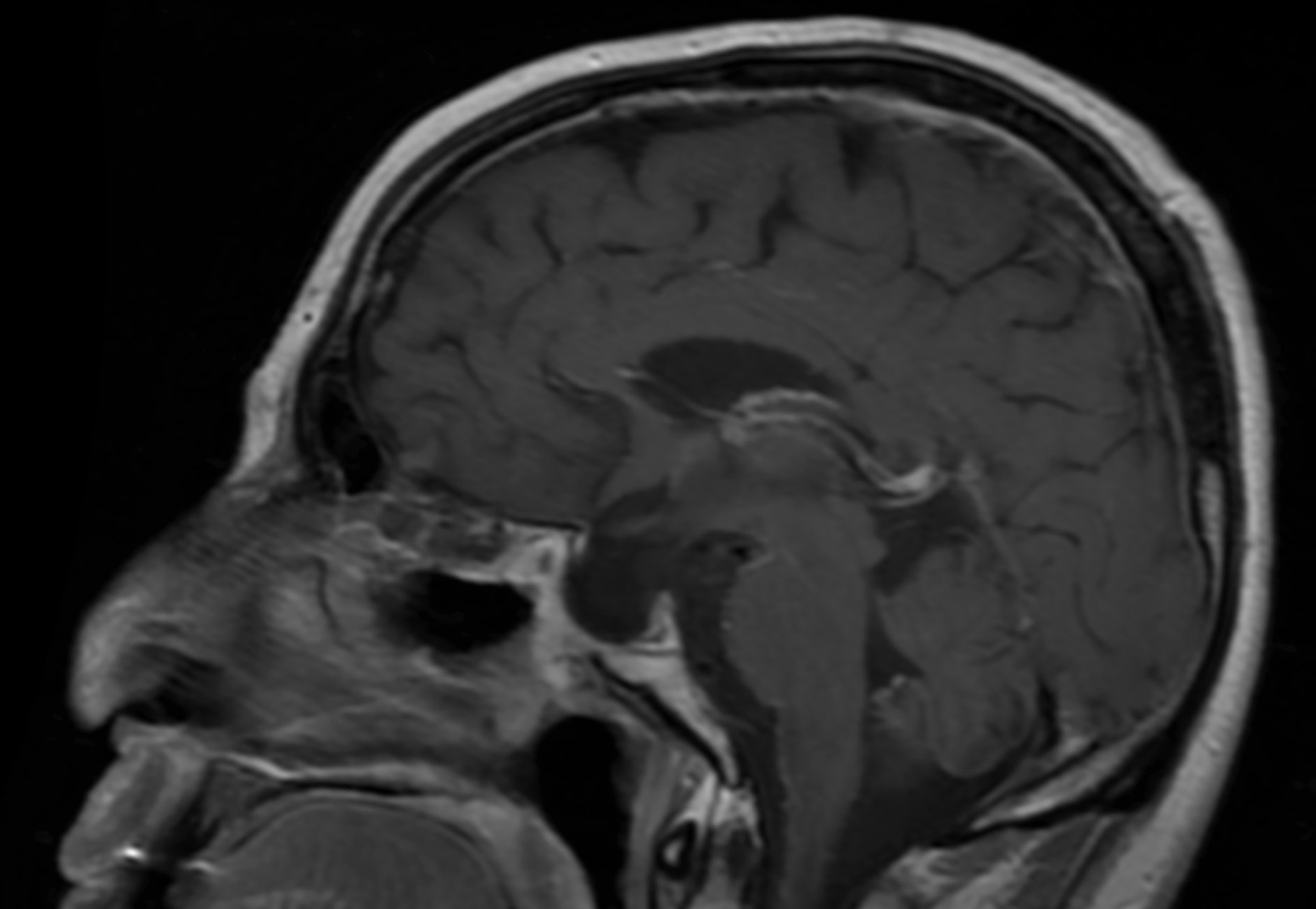 Una imagen en blanco y negro de un cerebro humano sobre un fondo negro.