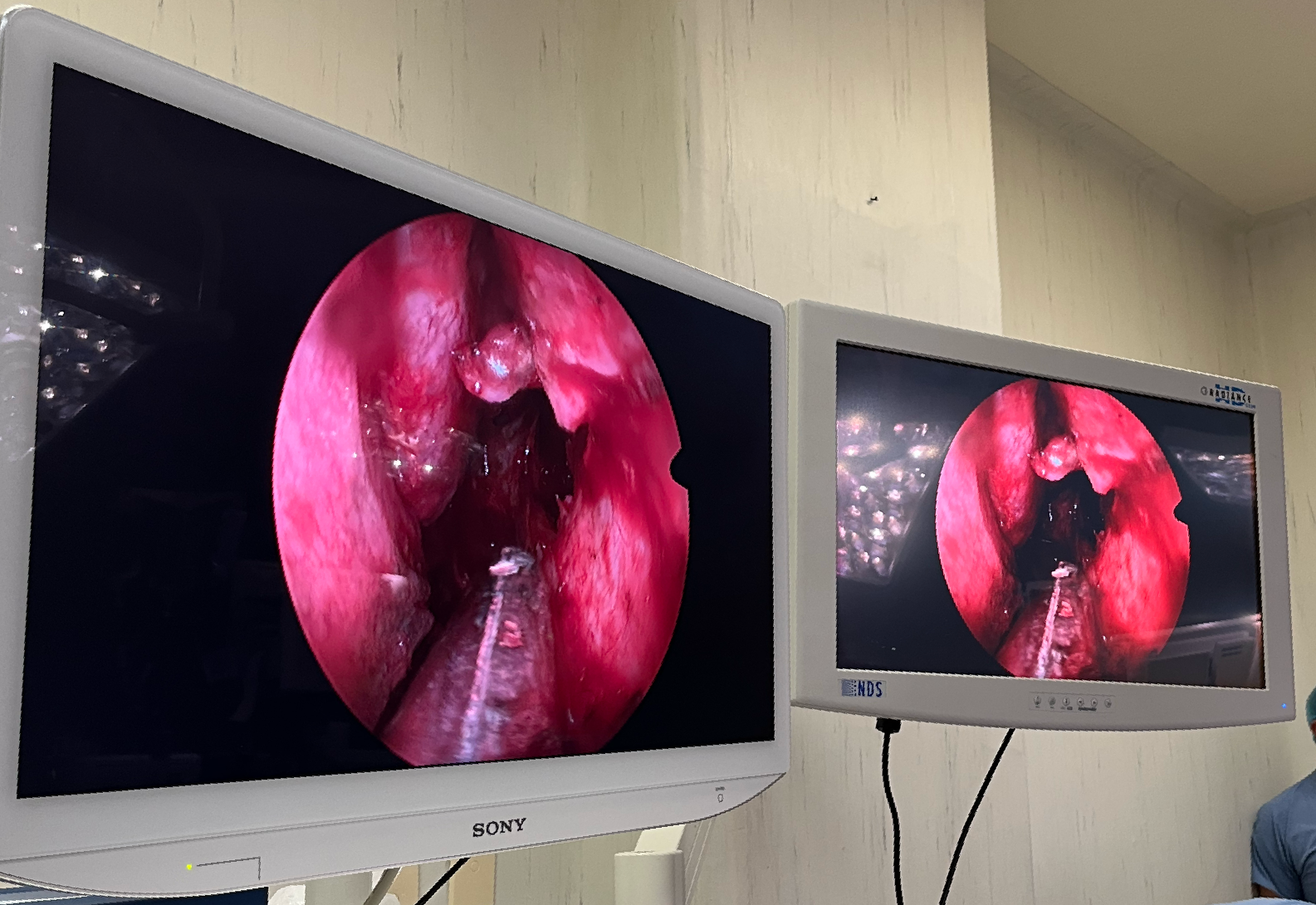 Dos monitores que muestran una imagen de un procedimiento quirúrgico.