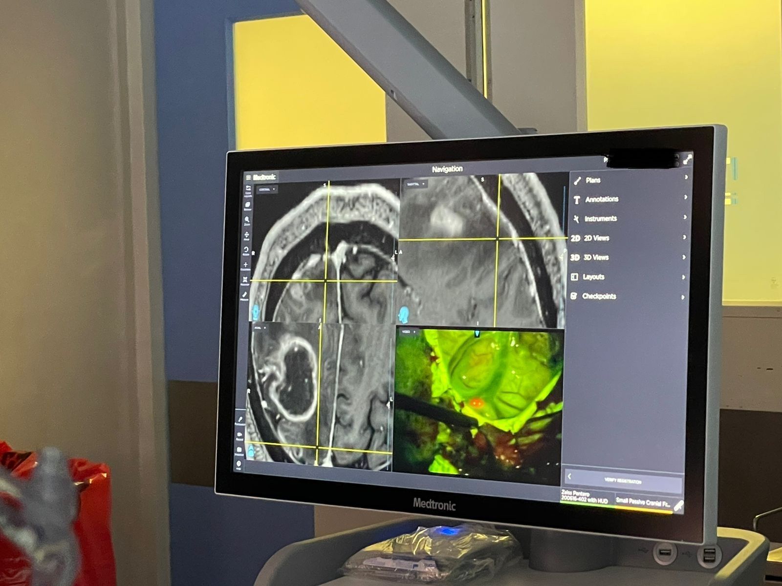 Un monitor de medtronic muestra una resonancia magnética de un cerebro